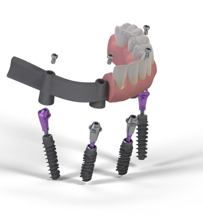 Full-Arch-Rekonstruktionen mit Sofortversorgung und Sofortbelastung auf 4–6 Implantaten
