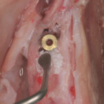 Hands-on Kurs - Periimplantitistherapie