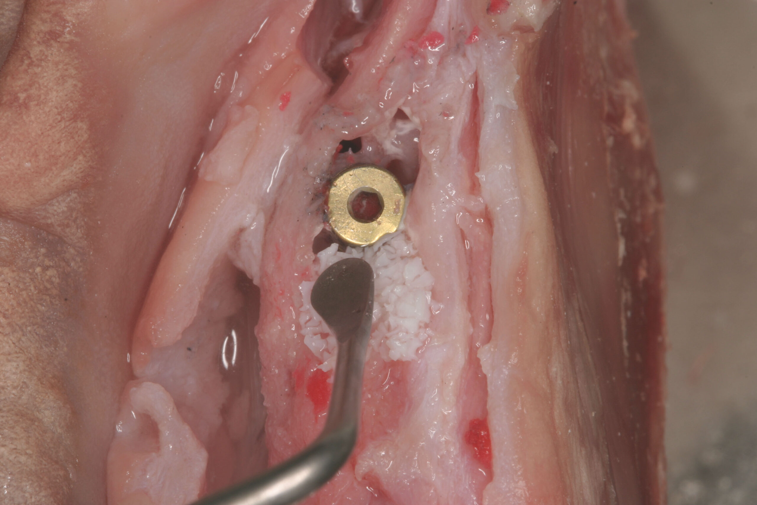 Hands-on Kurs - Periimplantitistherapie