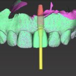 Digitale Planung als Grundlage moderner Implantatprothetik