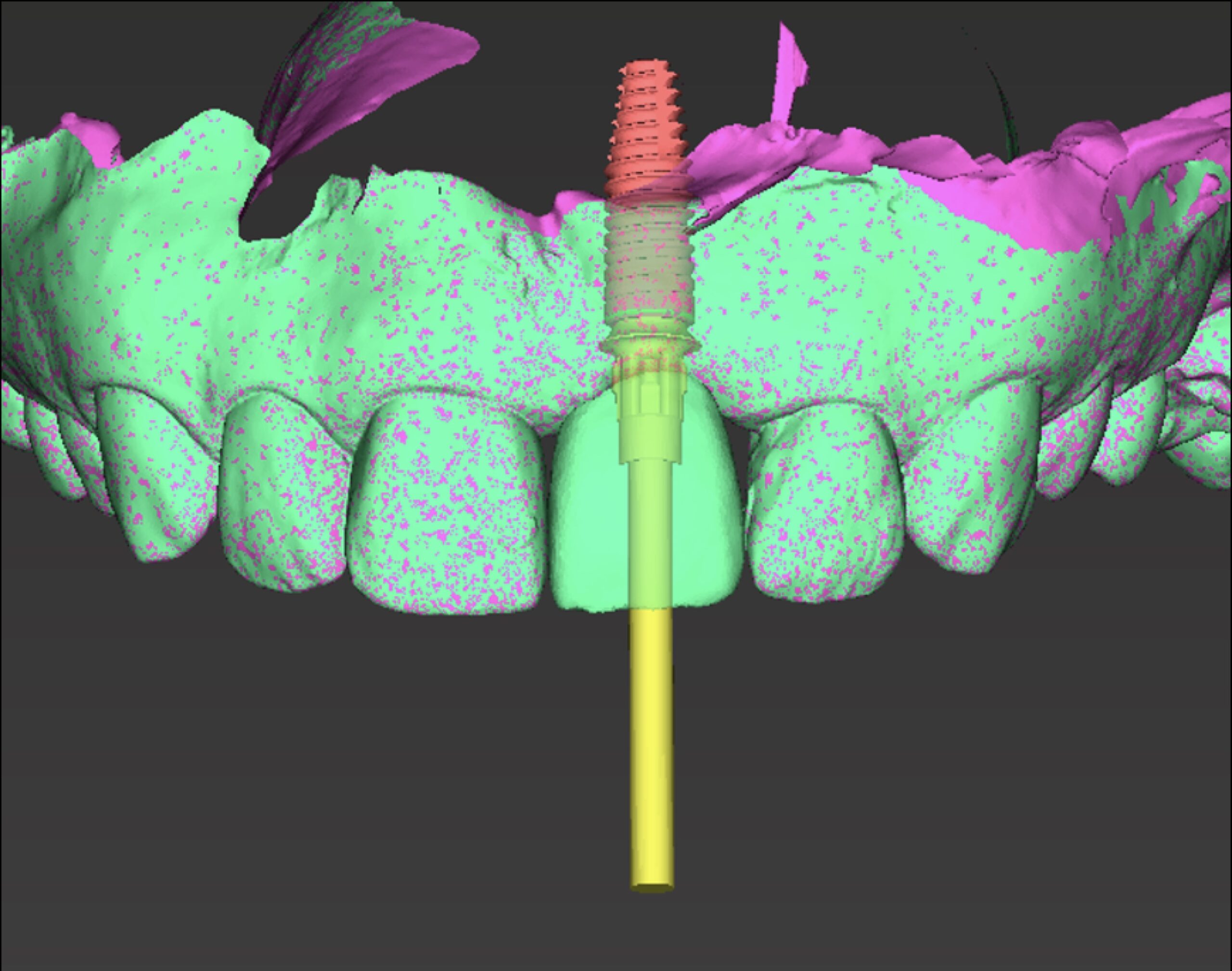 Digitale Planung als Grundlage moderner Implantatprothetik