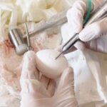 Sinuslift: Ein praktischer Kurs mit Hands-on-Training